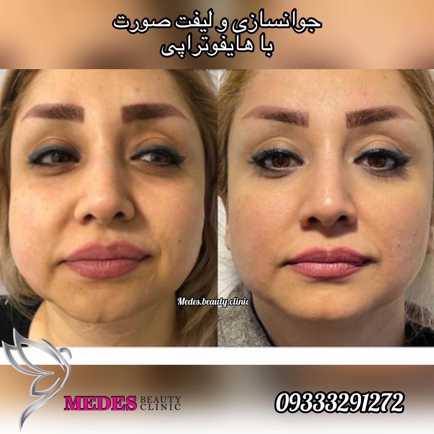 گالری هایفوتراپی